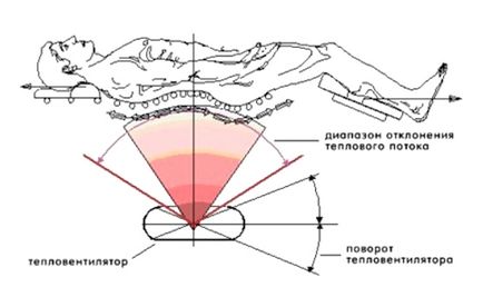 Deformarea spondilartrozei coloanei vertebrale lombare - tratamentul bolii