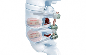 Deformarea spondilartrozei coloanei vertebrale lombare - tratamentul bolii