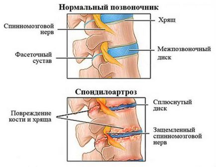 Deformarea spondilartrozei coloanei vertebrale lombare - tratamentul bolii