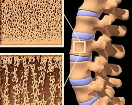 Densitometria coloanei vertebrale (diagnosticul de osteoporoză) ce este?