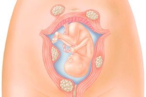 Diagnosticul și tratamentul fibromilor uterini planifică corect sarcina!