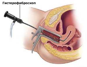 Diagnosticul și tratamentul fibromilor uterini planifică corect sarcina!