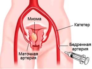 Діагностика та лікування міоми матки плануємо вагітність правильно!