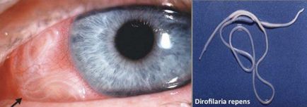 Dirofilariasis în simptomele umane și tratamentul ocular