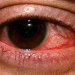 Дирофіляріоз у людини симптоми і лікування очей