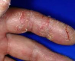 Eczemă dishidrotică - cauze, simptome, diagnostic și tratament
