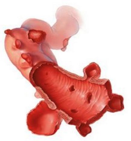 Diverticuloza colonului sigmoid, simptomele și tratamentul sigma diverticulului, dieta și nutriția, perforarea,