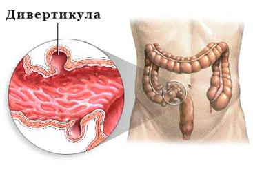 Дивертикулез сигмовидної кишки, симптоми і лікування дивертикула сигми, дієта і харчування, перфорація,