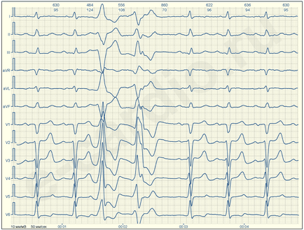 E-cardio ventrikuláris arritmiát