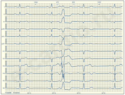 Extrasistol ventricular E-cardio