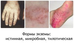 Eczeme cauze, simptome și tratament (unguente și pastile)