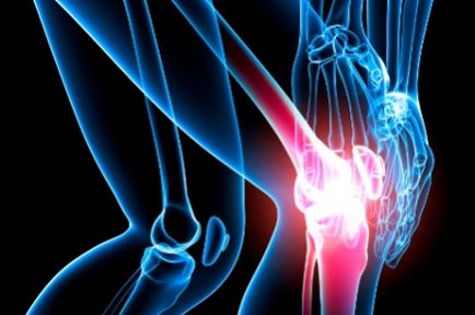 Epicondilită a simptomelor articulației genunchiului, tratament și prevenire