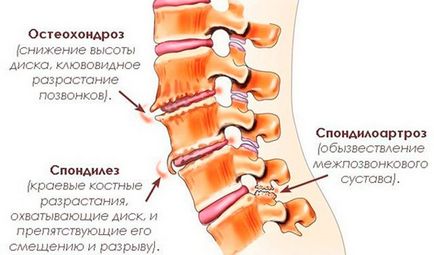 Articulațiile fatete ale normei și patologiei coloanei vertebrale