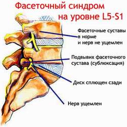 фасеточний синдром