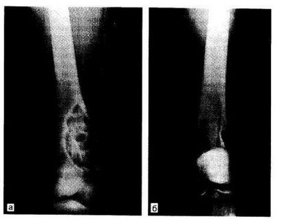 Dysplasia osoasă cartilagină fibroasă