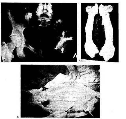 Dysplasia osoasă cartilagină fibroasă