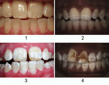 Fogászati ​​fluorosis 1