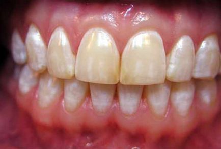 Флюороз зубів причини, симптоми, лікування, фото, ціни на ендемічний флюороз зубів, профілактика