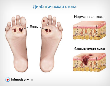 Гангрена при цукровому діабеті