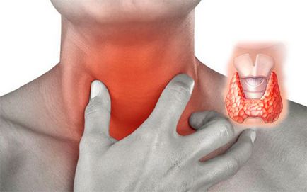Hipertiroidismul glandei tiroide, simptome, diagnostic și tratament