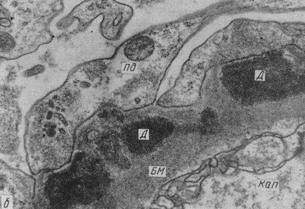 hártyás glomerulonephritis