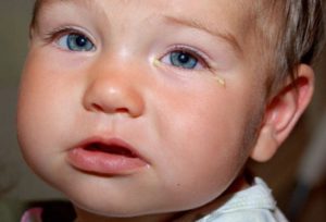 Ochii Gnoyatsya și nasul curge în copil, puneți din ochi cu o răceală la copil