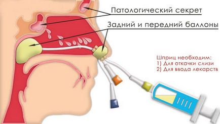 Гнійний етмоїдит - лікування і причини хвороби