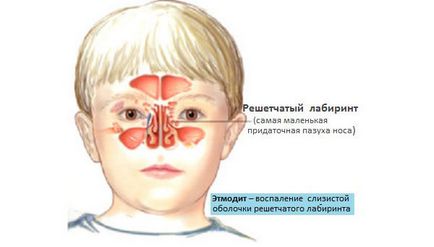 Puritatentă etmoidită - tratamentul și cauzele bolii