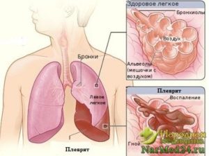 Pleurisia purulentă a simptomelor pulmonare, tratamentul, consecințele