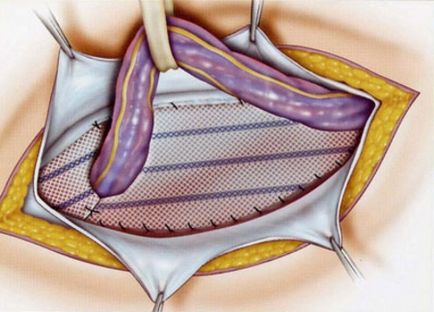 Hernia chirurgie a herniilor secolului XX