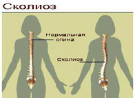 Ідіопатичний сколіоз »spine❺