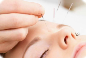 Acupunctura, reflexoterapia, acupunctura in tratamentul migrenei si dureri de cap