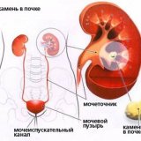 Acupunctura împotriva pietrelor la rinichi - bisturiu - informații medicale și portal educațional