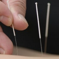 Acupunctura împotriva pietrelor la rinichi - bisturiu - informații medicale și portal educațional