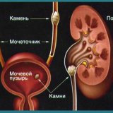 Acupunctura împotriva pietrelor la rinichi - bisturiu - informații medicale și portal educațional