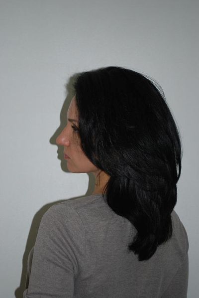 Intenzív terápia hajátültetés és a méregtelenítés Perola Marcia Teixeira