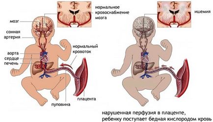 Ішемія головного мозку у новонароджених