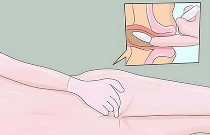 Ihtiolovye gyertyák prosztata használati utasítást, valós (prostatitis) Ihtiolovye gyertyák prosztata használati utasítás, vélemények