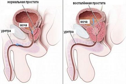 Іхтіолові свічки при простатиті відгуки та застосування