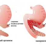 Ce este fitoterapia pentru pancreatită?
