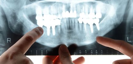 Як підготуватися до імплантації зубів