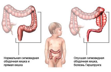 Cum este boala hirschspring la copii fotografii, simptome, tratament și intervenții chirurgicale