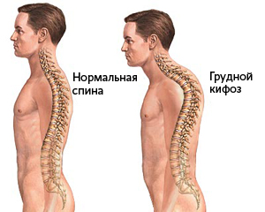 Kyphosis a mellkasi gerinc 1, 2, 3 fok a tünetek és a kezelés