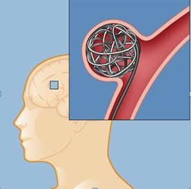 Clonarea anevrismelor cerebrale, perioada postoperatorie