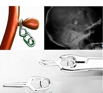 Clonarea anevrismelor cerebrale, perioada postoperatorie