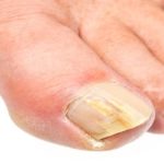 Лікування грибка нігтів домашніми засобами