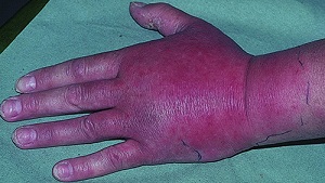Лікування лімфостазу рук після мастектомії (видалення молочних залоз при раку)