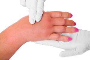 Tratamentul limfostaziei mâinilor după mastectomie (eliminarea glandelor mamare cu cancer)