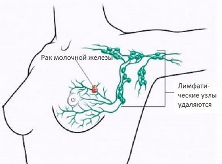 Tratamentul limfostaziei mâinilor după mastectomie (eliminarea glandelor mamare cu cancer)