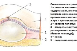 Tratamentul lipomului